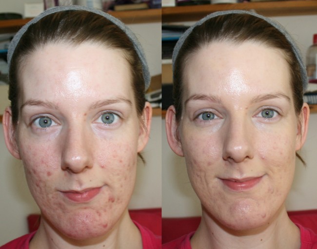 BareMinerals BareSkin Foundation Before and After